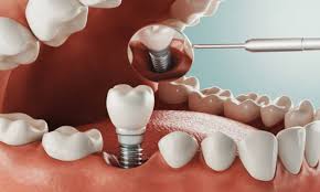 Dental Implants