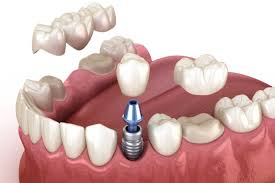 Dental Crowns & Bridges