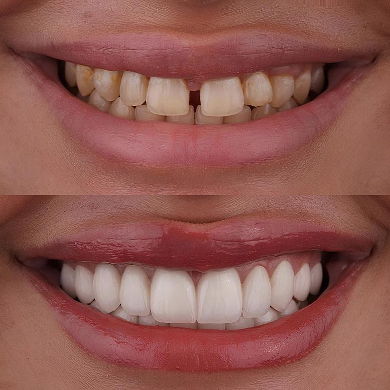 Smile Makeover